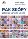 RAK SKÓRY LECZENIE METODĄ MOHSA A BIENIEK Z WOŹNIAK  